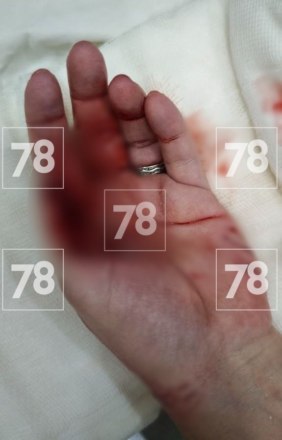 Зубастая нянька до крови покусала туристку в Таиланде