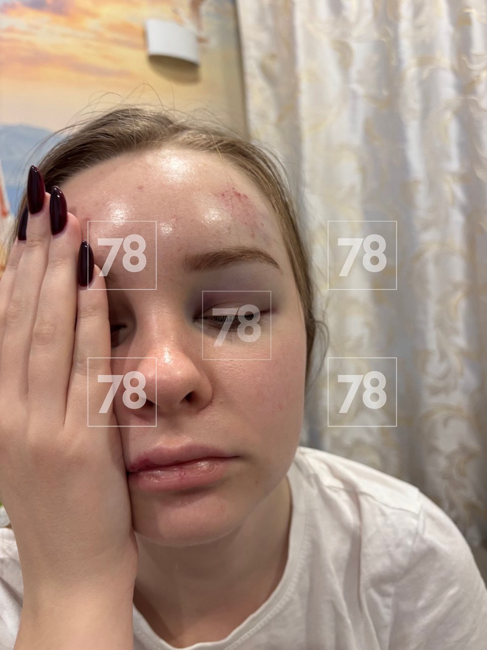 «Поехал не по своей траектории, неадекватное вождение»: пострадавшая петербурженка рассказала о ЧП с аэролодкой в Карелии «Поехал не по своей траектории, неадекватное вождение»: пострадавшая петербурженка рассказала о ЧП с аэролодкой в Карелии