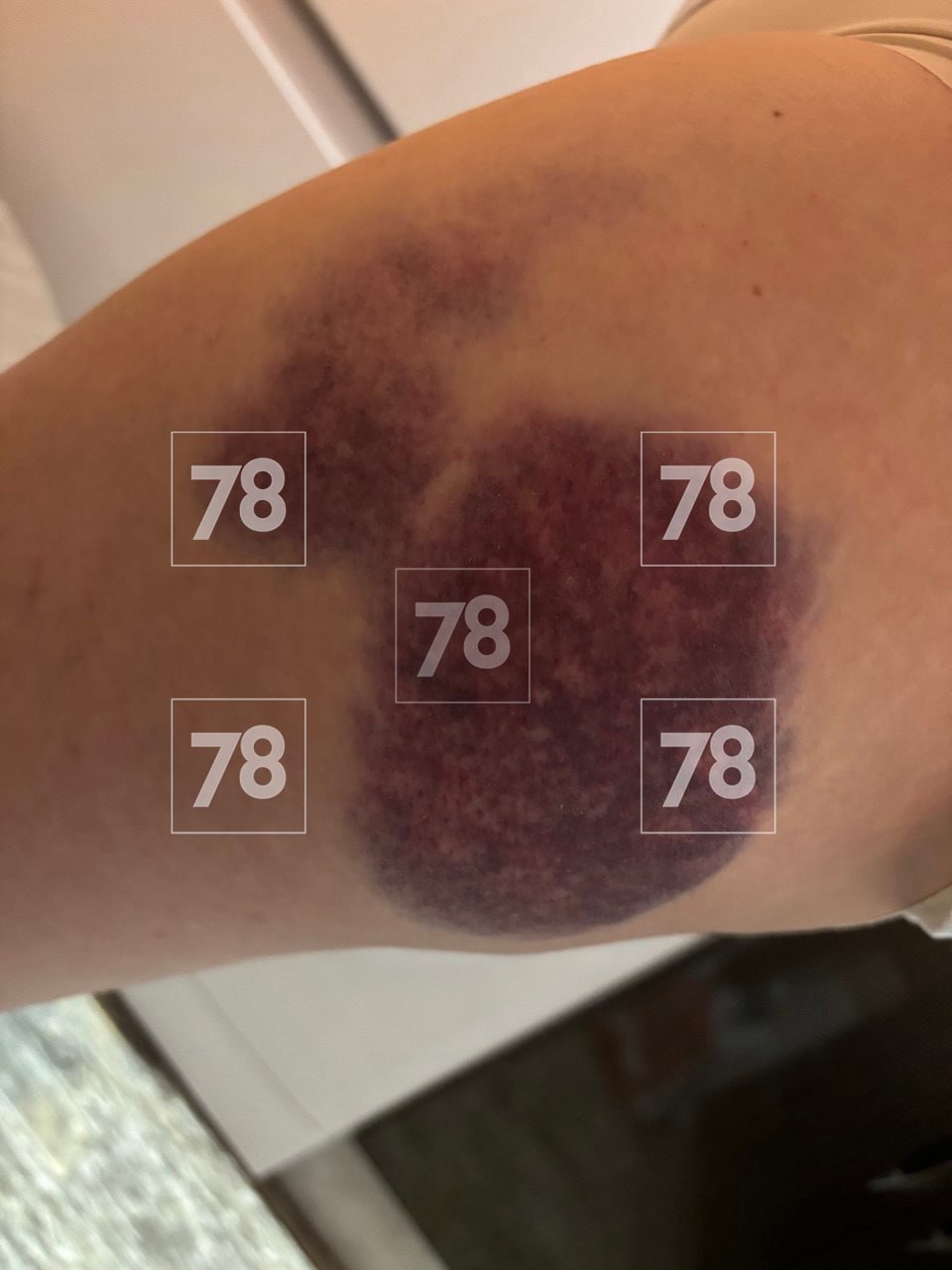 «Поехал не по своей траектории, неадекватное вождение»: пострадавшая петербурженка рассказала о ЧП с аэролодкой в Карелии