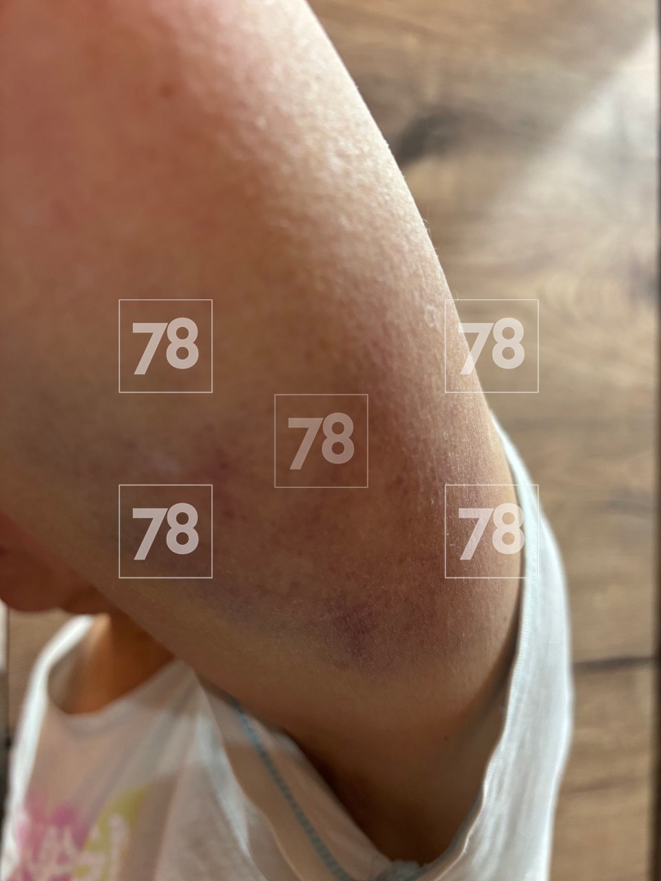 «Поехал не по своей траектории, неадекватное вождение»: пострадавшая петербурженка рассказала о ЧП с аэролодкой в Карелии «Поехал не по своей траектории, неадекватное вождение»: пострадавшая петербурженка рассказала о ЧП с аэролодкой в Карелии