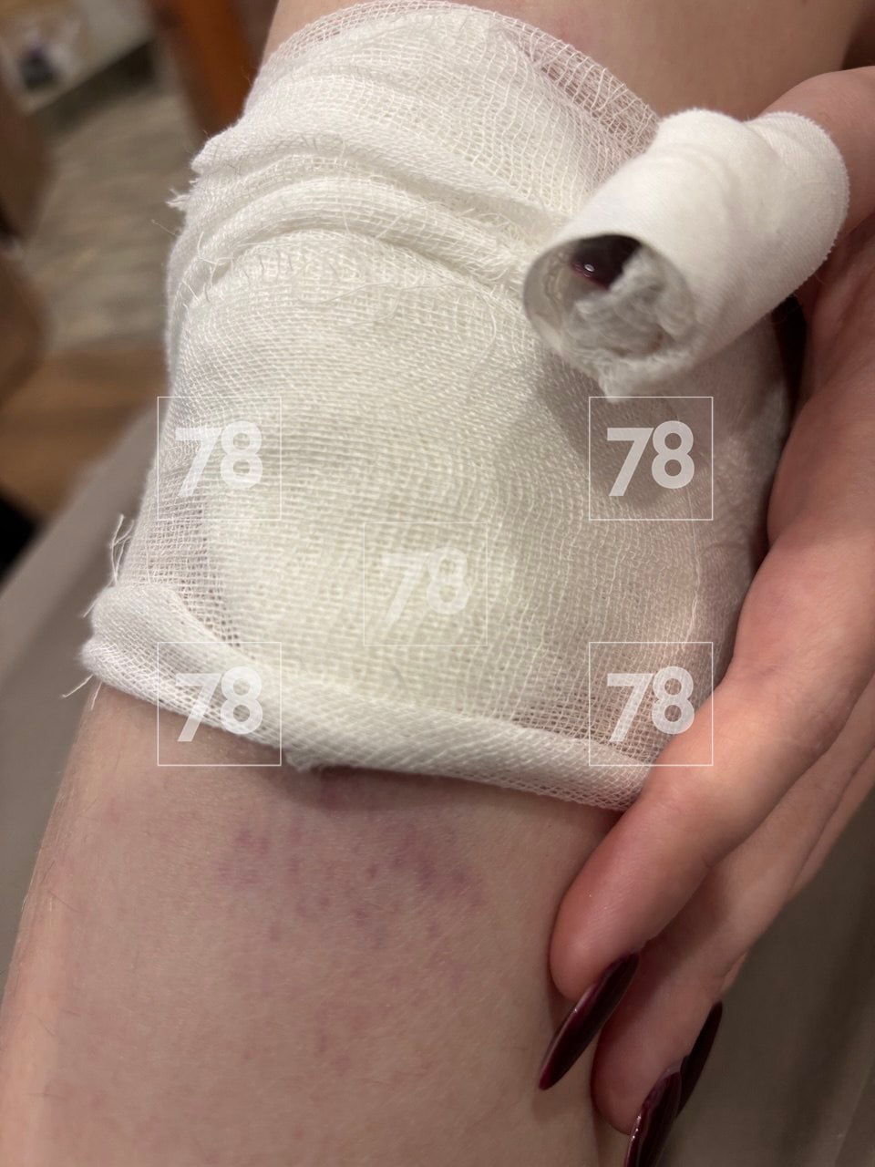 «Поехал не по своей траектории, неадекватное вождение»: пострадавшая петербурженка рассказала о ЧП с аэролодкой в Карелии «Поехал не по своей траектории, неадекватное вождение»: пострадавшая петербурженка рассказала о ЧП с аэролодкой в Карелии