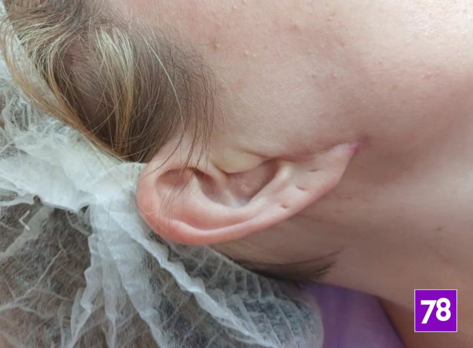 Клиника «Абриелль», где в 2023 году умерла пациентка, продолжает уродовать своих клиентов