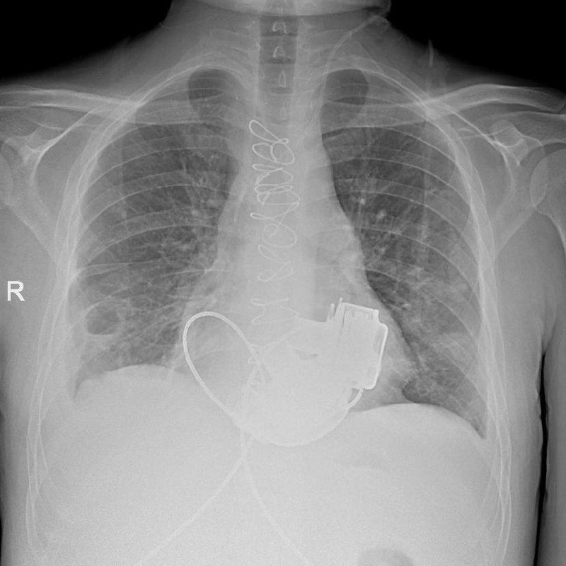 В Петербурге готовят к выписке уникального пациента без пульса