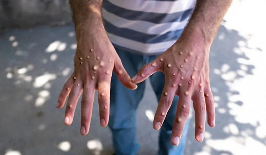 Нежеланный гость: Обезьянья оспа добралась до Питера