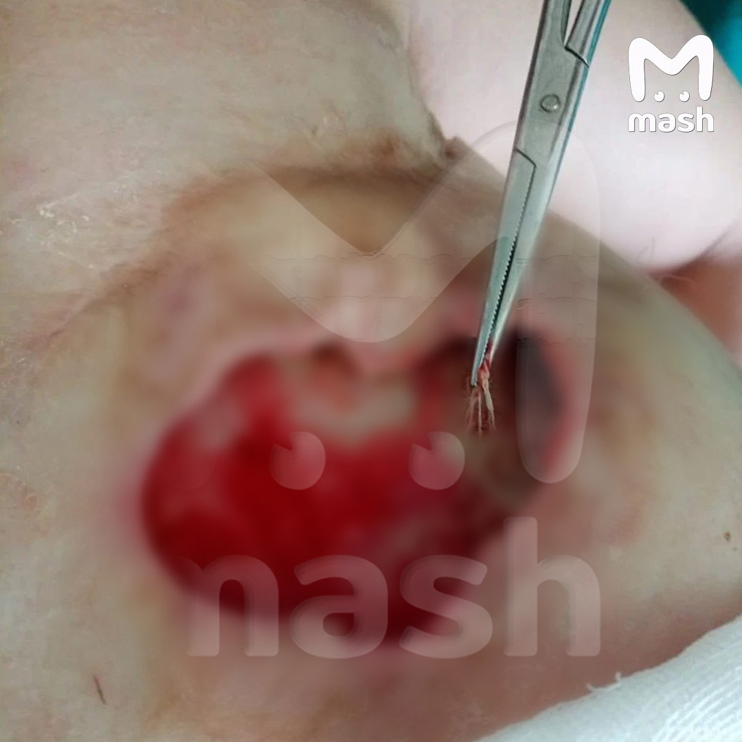 Жительница Тулы год прожила с салфеткой в груди — которую забыл внутри пластический хирург во время операции в питерской клинике Жительница Тулы год прожила с салфеткой в груди — которую забыл внутри пластический хирург во время операции в питерской клинике