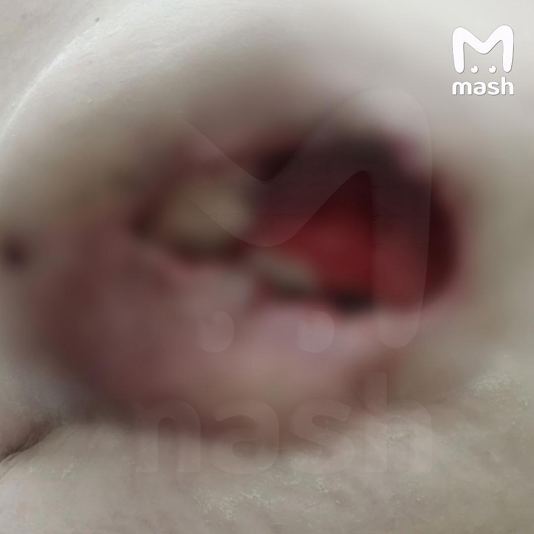 Жительница Тулы год прожила с салфеткой в груди — которую забыл внутри пластический хирург во время операции в питерской клинике Жительница Тулы год прожила с салфеткой в груди — которую забыл внутри пластический хирург во время операции в питерской клинике