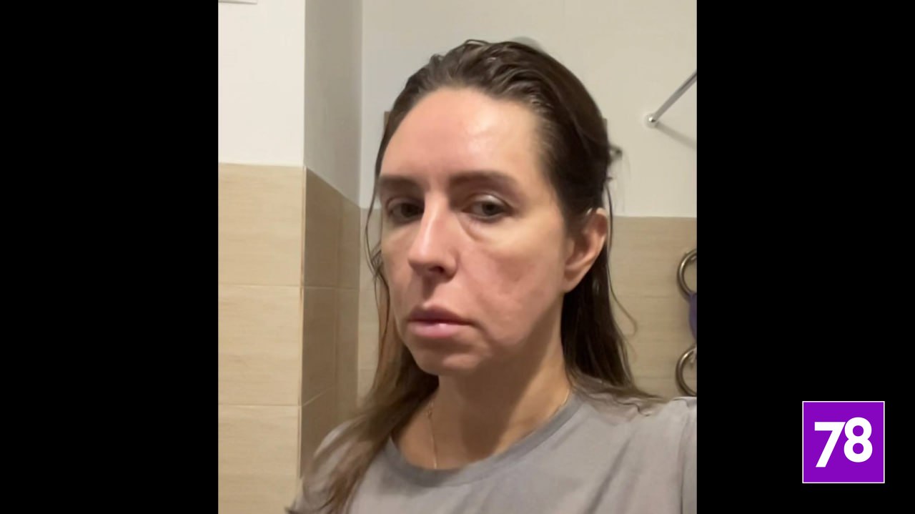 «Кожа была как тряпка в месте вкола»: петербурженка пострадала после посещения косметолога «Кожа была как тряпка в месте вкола»: петербурженка пострадала после посещения косметолога