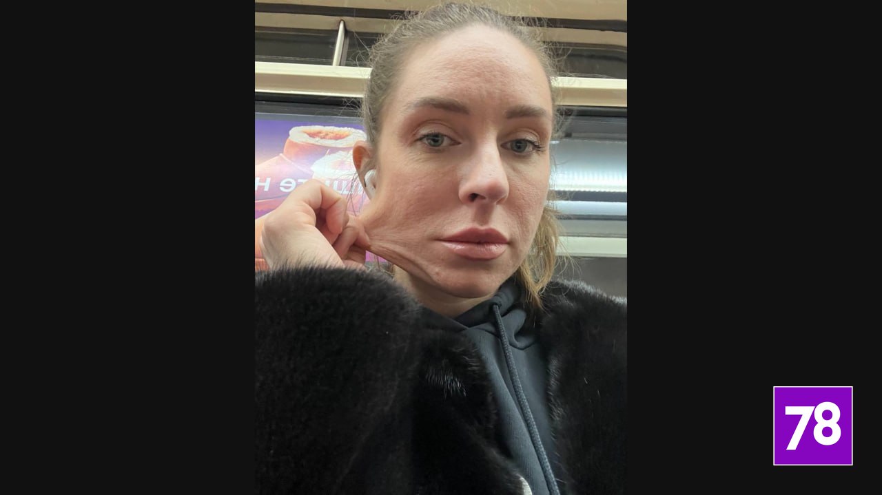 «Кожа была как тряпка в месте вкола»: петербурженка пострадала после посещения косметолога