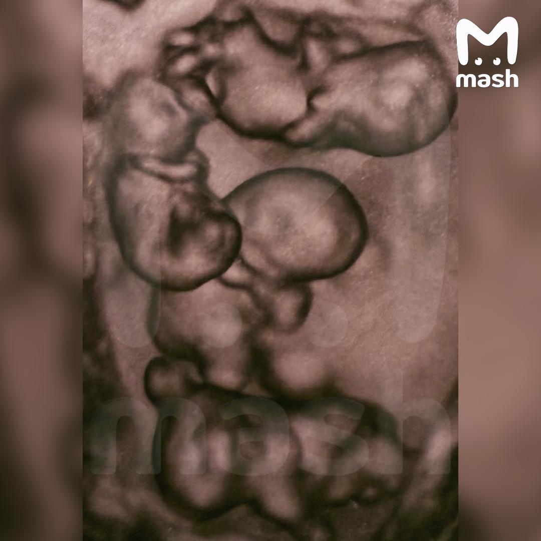 Впервые в России женщина родила однояйцевую четверню — такое происходит 1 раз в 15,5 миллиона родов Впервые в России женщина родила однояйцевую четверню — такое происходит 1 раз в 15,5 миллиона родов