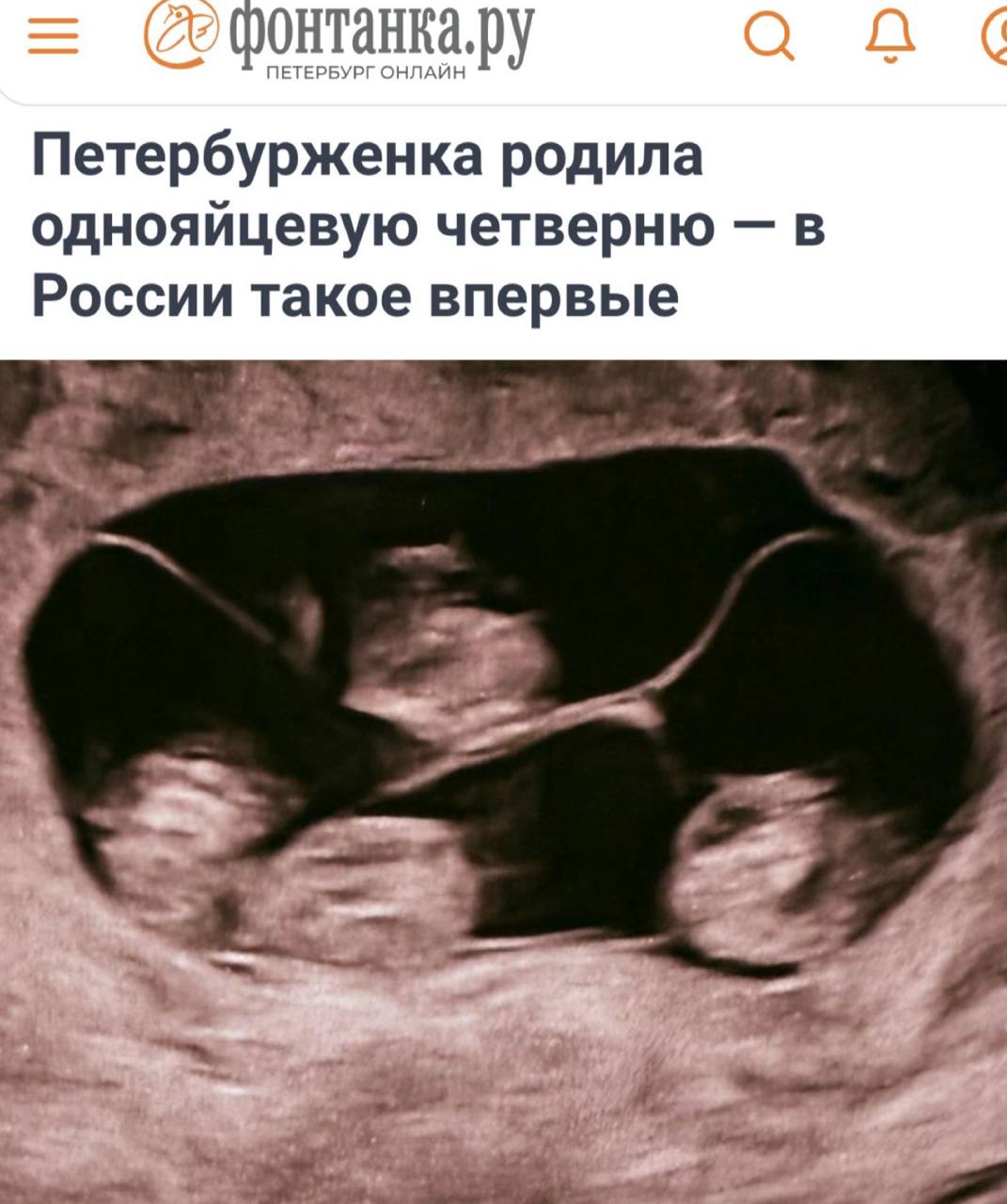«Петербурженка родила однояйцевую четверню»: Это первый подобный случай в России