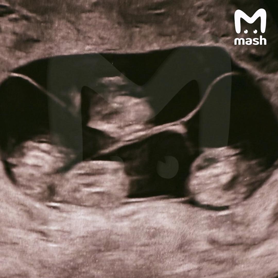 Впервые в России женщина родила однояйцевую четверню — такое происходит 1 раз в 15,5 миллиона родов Впервые в России женщина родила однояйцевую четверню — такое происходит 1 раз в 15,5 миллиона родов