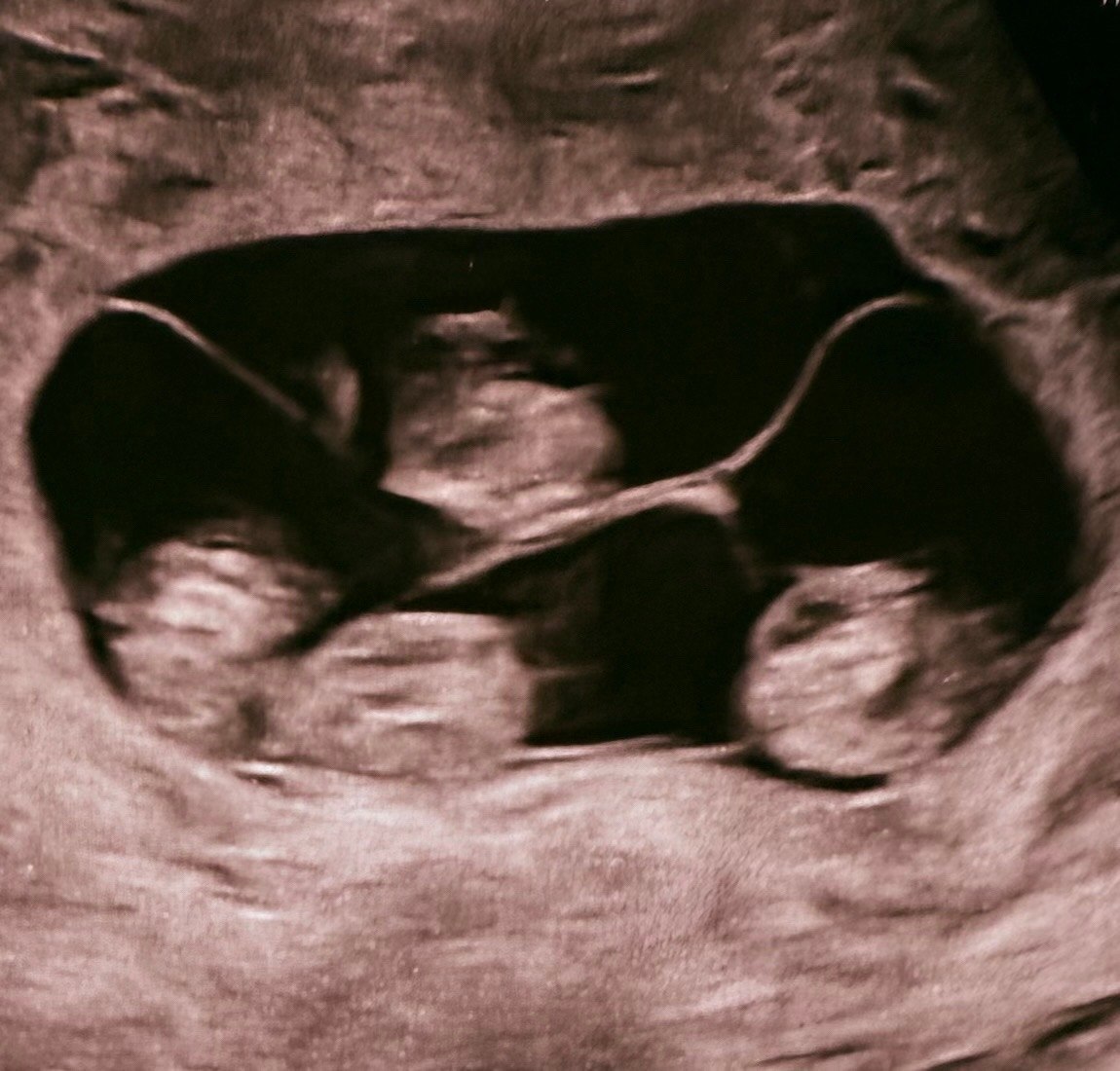 В Петербурге женщина родила сразу четырех девочек, причем все они — однояйцевые близнецы В Петербурге женщина родила сразу четырех девочек, причем все они — однояйцевые близнецы