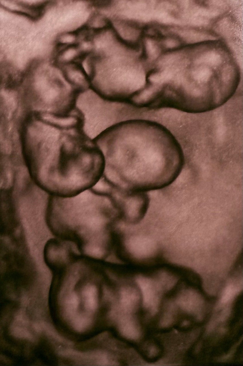 В Петербурге женщина родила сразу четырех девочек, причем все они — однояйцевые близнецы В Петербурге женщина родила сразу четырех девочек, причем все они — однояйцевые близнецы