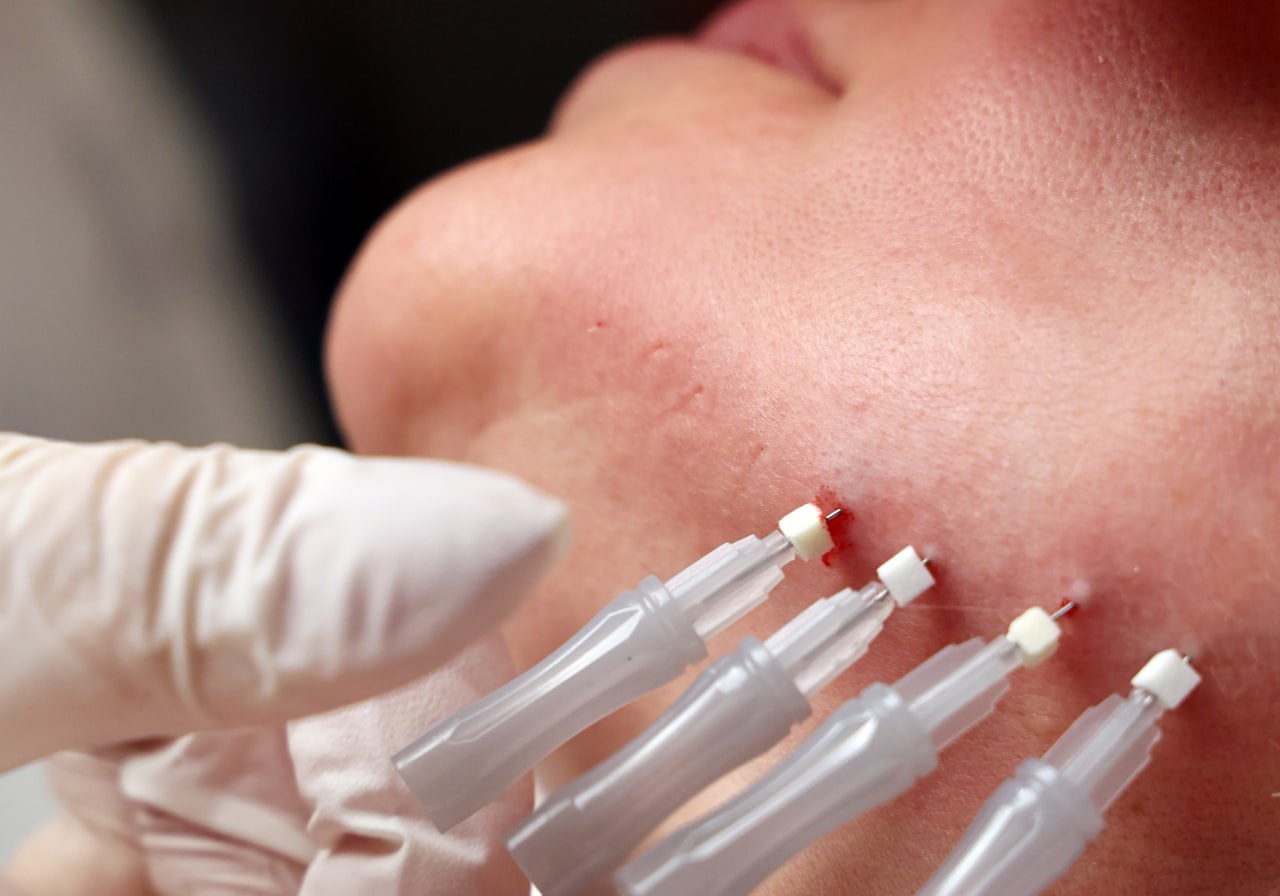 Что происходит на рынке эстетической медицины в Петербурге и почему эти услуги не всегда безопасны? Ответы на эти вопросы искали депутаты Заксобрания вместе с экспертами — врачами, представителями прокуратуры и других...