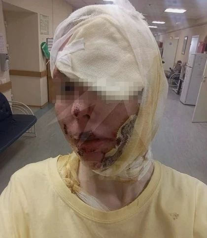 Петербурженка, которой бывший облил кислотой, лишилась левого глаза