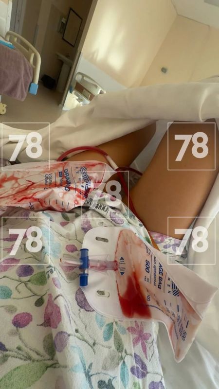 Разрыв яичников случился у петербурженки во время процедуры ЭКО Разрыв яичников случился у петербурженки во время процедуры ЭКО