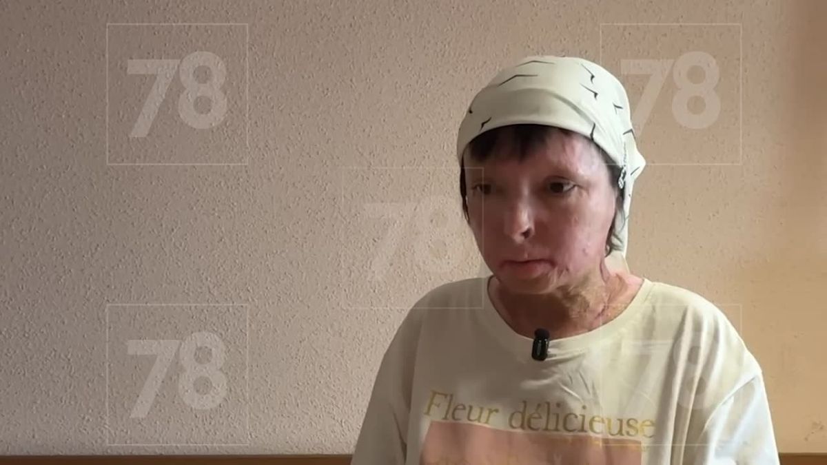 «Не могу даже умыть ребенка»: подожженная любовница в Парголово рассказала о жизни после трагедии