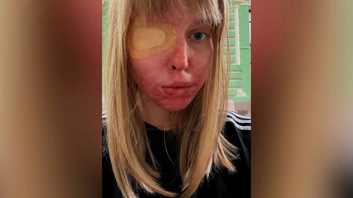 «Я здесь. Я живу»: петербурженка, облитая кислотой бывшим, не намерена сдаваться
